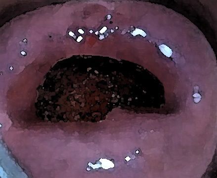 私の蟲姦遊び 17 話 妊娠中にスズメガのサナギ編