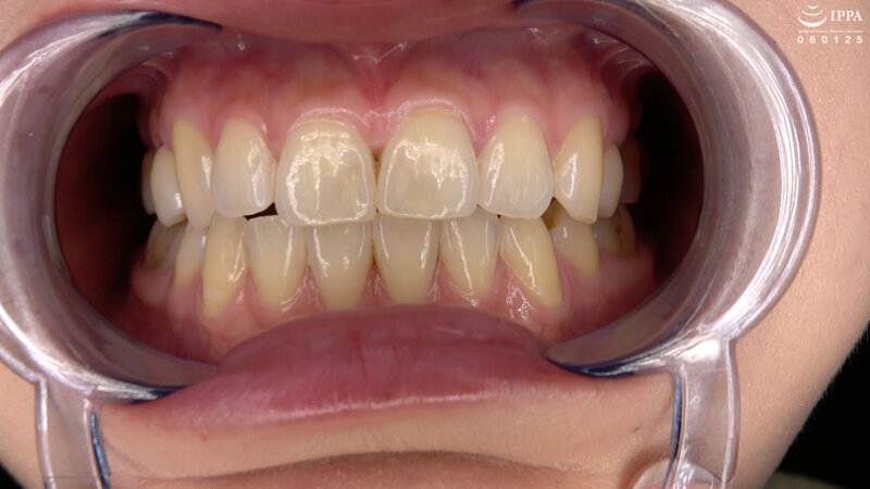 【歯・口内フェチ】綺麗なお姉さんの激レアな治療跡がある歯・口内・のどちんこ観察! 美泉咲