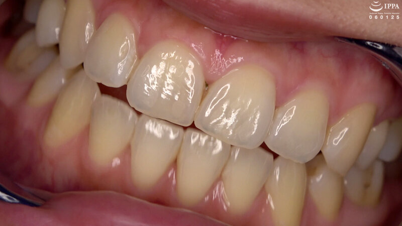 【歯・口内フェチ】綺麗なお姉さんの激レアな治療跡がある歯・口内・のどちんこ観察! 美泉咲