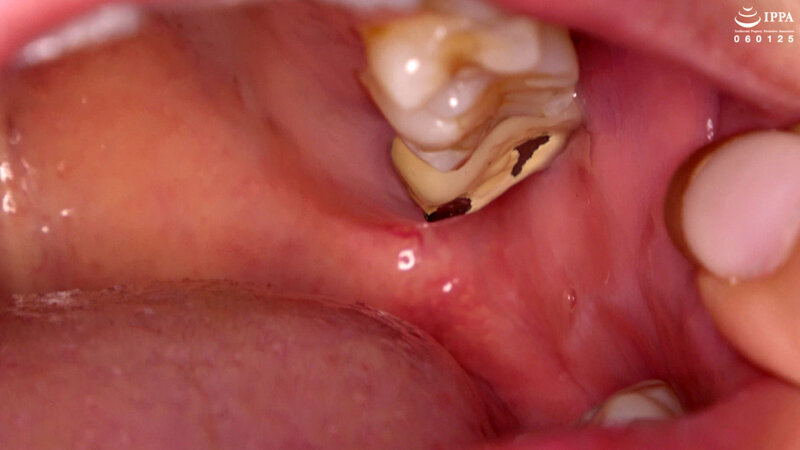 【歯・口内フェチ】綺麗なお姉さんの激レアな治療跡がある歯・口内・のどちんこ観察! 美泉咲