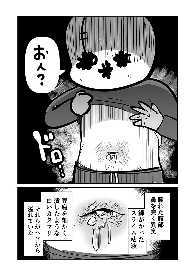 〆切に追われて栄養剤＋仮眠を繰り返していたらおヘソから膿が出て入院した話2